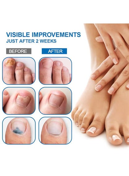 Sumifun Nail Fungus Treatment Liquid 20ml | Fast Acting
