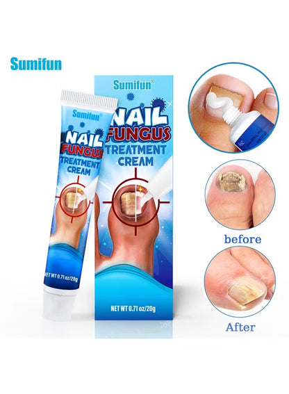 Sumifun Nail Fungus Treatment Liquid 20ml | Fast Acting